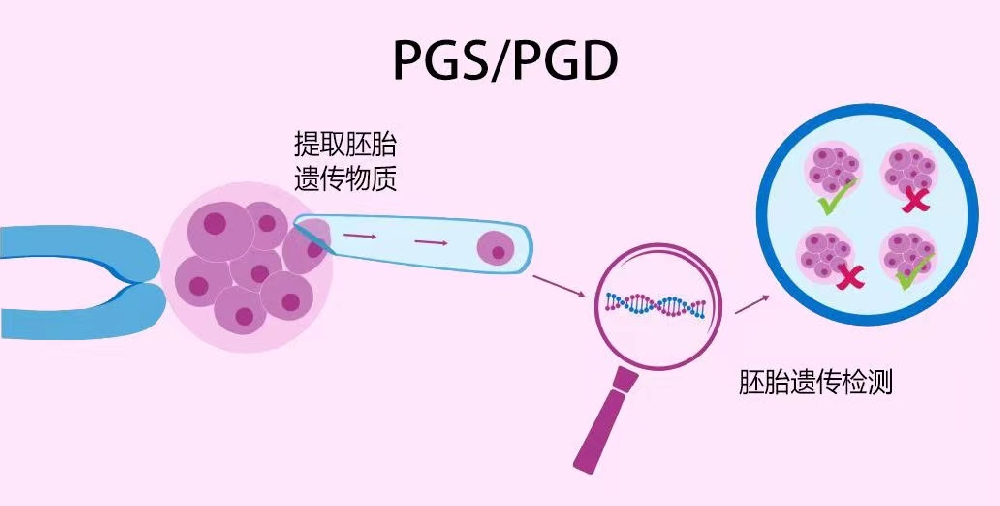 泰国第三代试管婴儿技术PGD/PGS